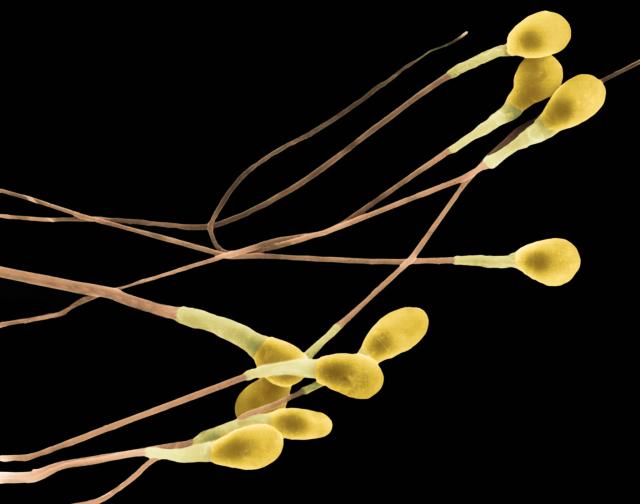 肥満は精子にエピジェネティックな変化を引き起こすことが判明