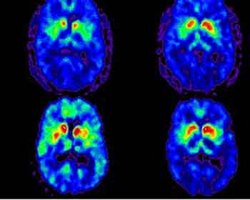 家族性パーキンソン病の新たな遺伝子変異を発見