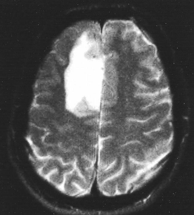 手術中に脳腫瘍のDNA解読可能なAIツール：最新研究結果が学術誌に掲載