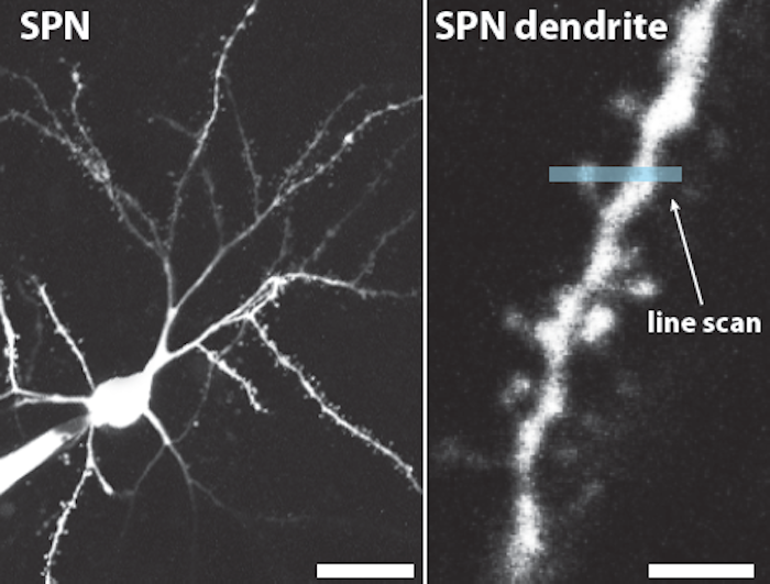 ハンチントン病の発症はDNA拡大が鍵：最新研究が解明する神経変性のメカニズム