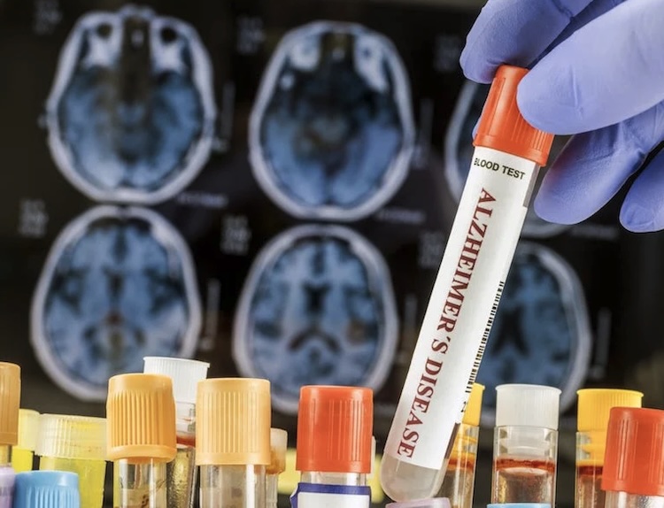 アルツハイマー病血液検査に新展開！ALZpath pTau217アッセイが高精度を示す