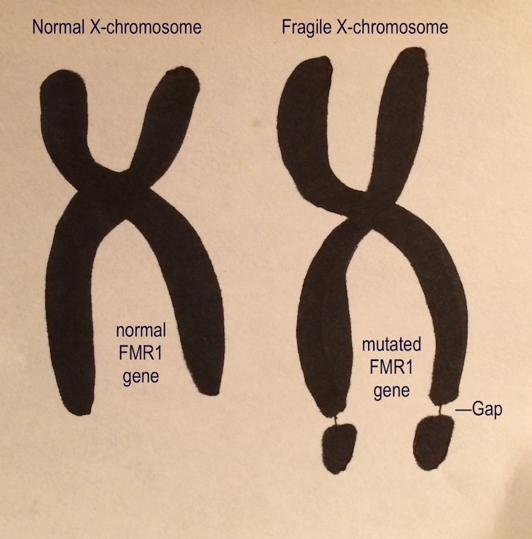 脆弱X症候群に新たな治療の光！MITがNMDA受容体サブユニット標的で症状改善