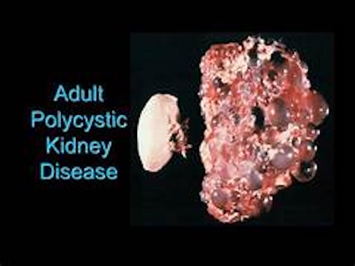 細胞の宅配便を追跡！難病・多発性嚢胞腎（PKD）治療への新たな道